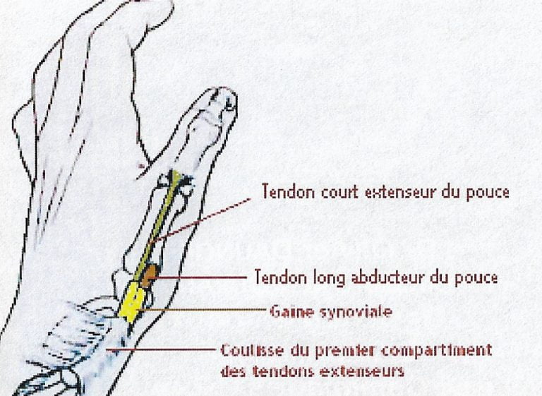 Le phlegmon de doigt Centre Main Aix en Provence — free download